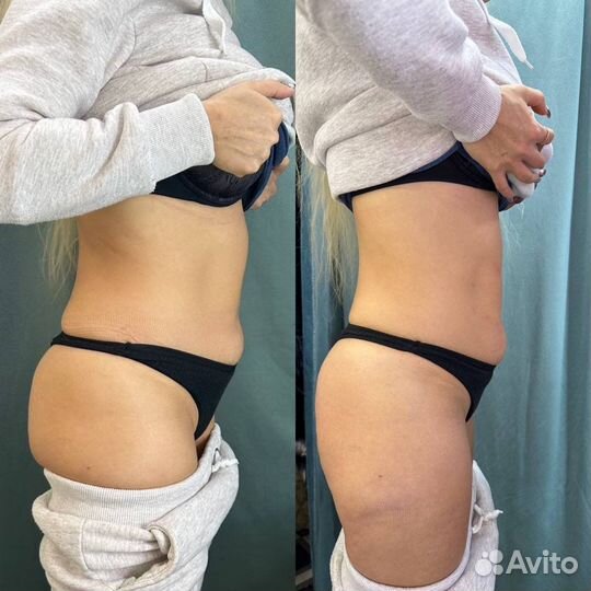 Липолитики тело