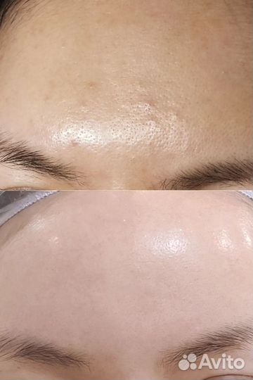 Пилинг для лица