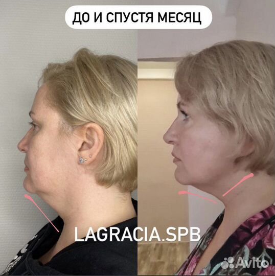 Модель SMAS lifting