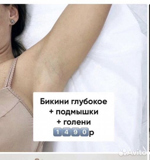 Лазерная эпиляция: подмышки