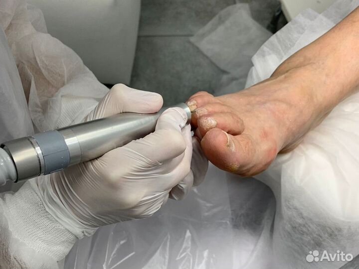 Медицинский педикюр от подолога