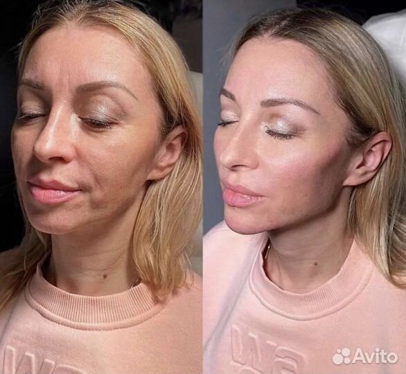 Full face омоложение