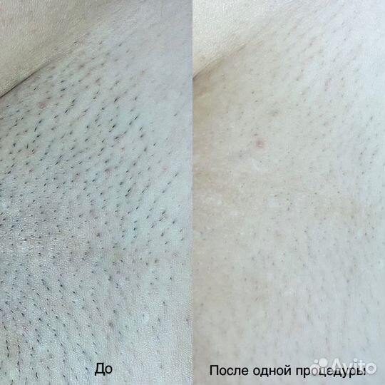 Лазерная эпиляция