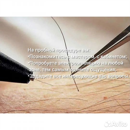 Электроэпиляция