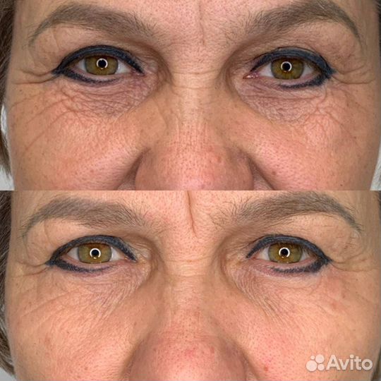 Услуги косметолога холодная плазма