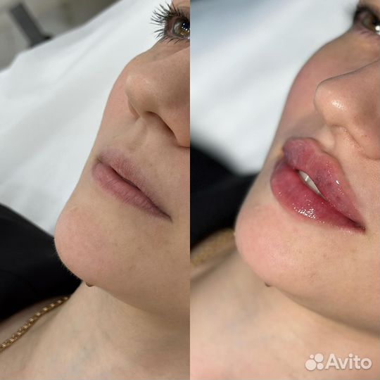 Модель на увеличение губ