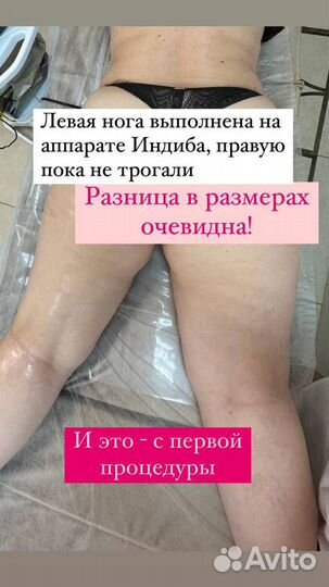 Индиба похудение, коррекция