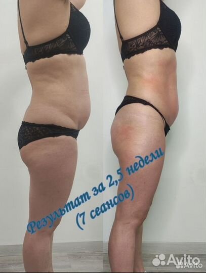 Аппаратная коррекция фигуры