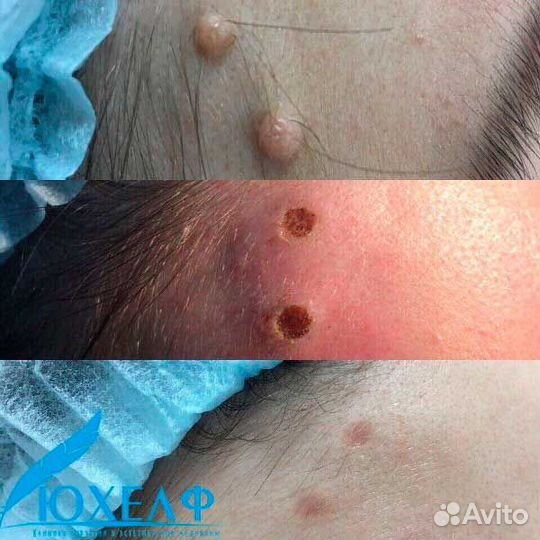 Удаление лазером родинок, папиллом, бородавок