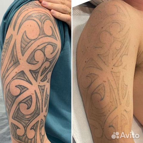 Лазерное удаление тату и татуажа