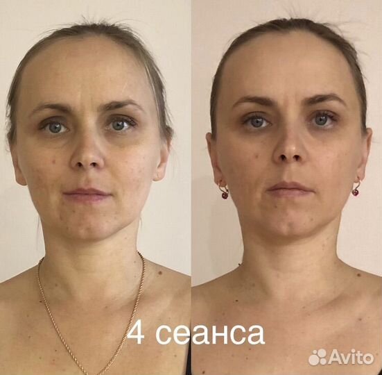 Фейспластика