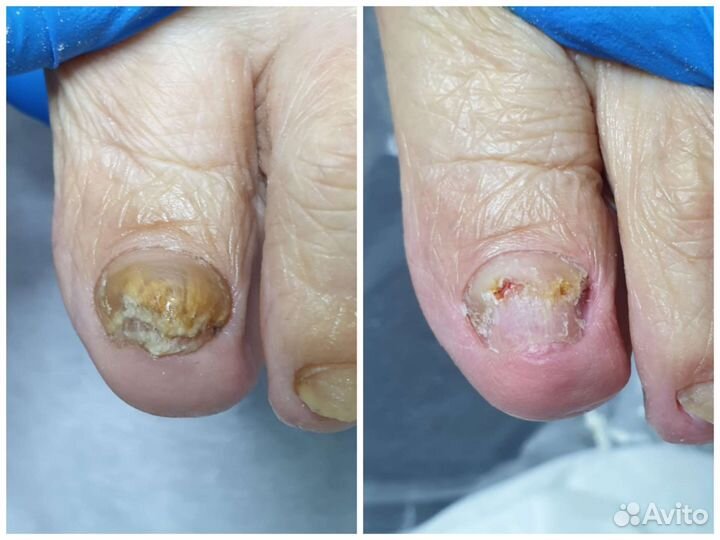 Подолог. Парамедицинский педикюр