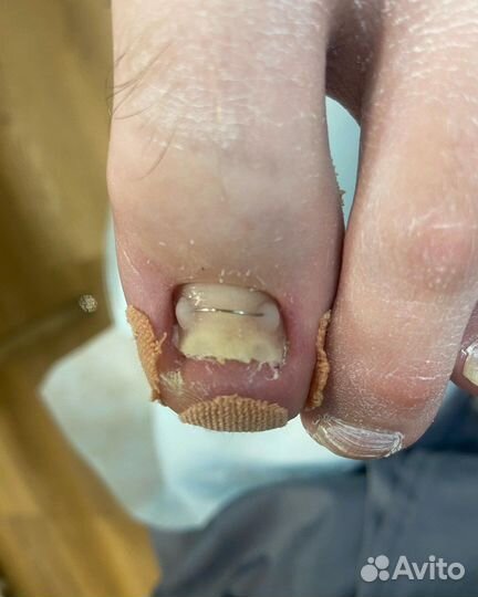 Установка коррекционной системы титановая нить