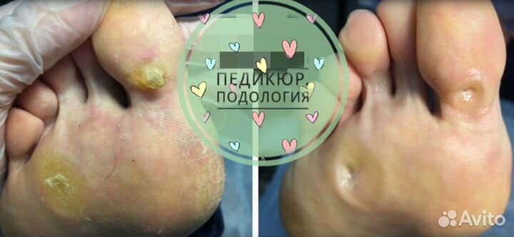 Педикюр лечебный (подология)