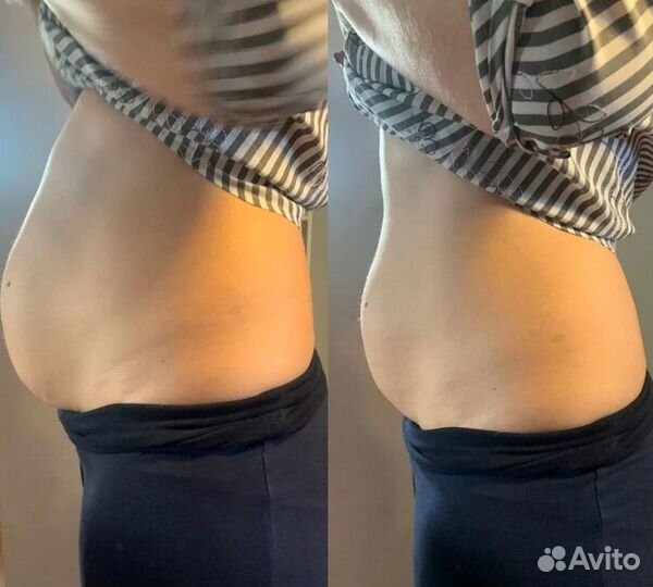 Плоский живот - размер за 1 процедуру