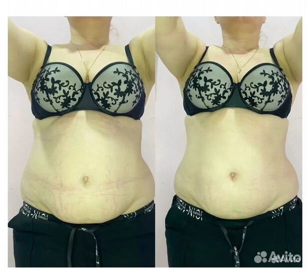 Липосакция без операции в Челябинске