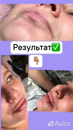 Увеличение губ, наращивание ресниц