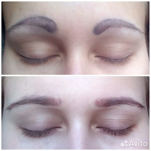 Лазерное удаление татуировки и пм