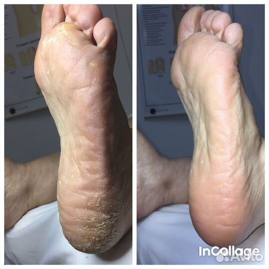 Педикюр/подология/ выезд на дом