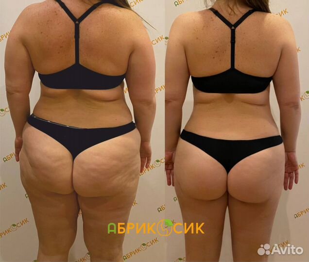 Lpg массаж, качественная проработка всего тела