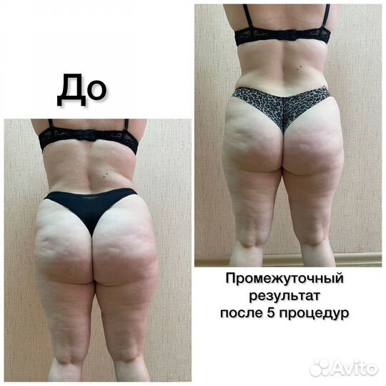 Массаж LPG оригинальный Французский