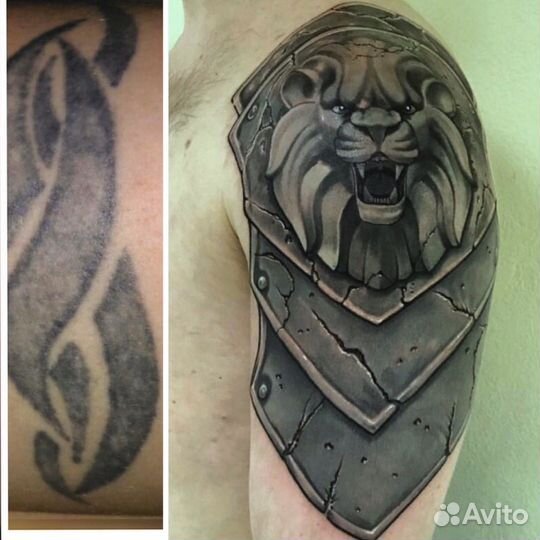 Удаление татуировок