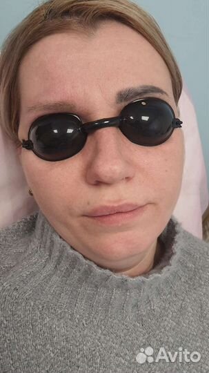 Лазерное удаление татуажа/тату