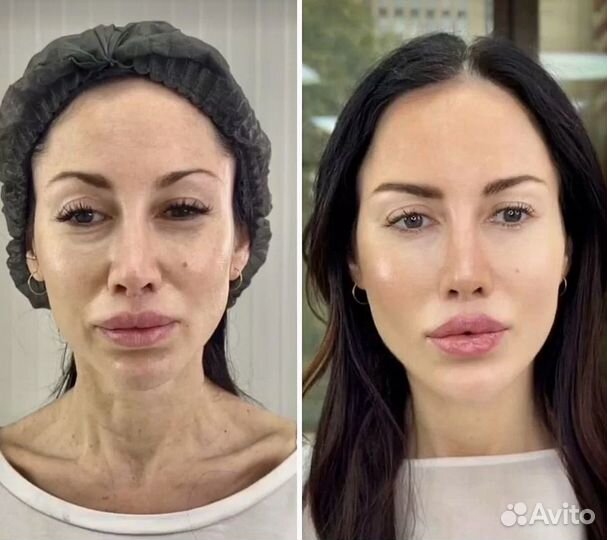 Омоложение -10 лет термолифтинг