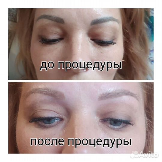 Удаление тату и татуажа лазером, карбоновый пилинг