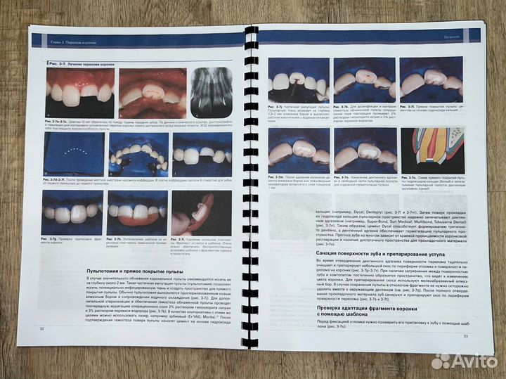 Травма зубов