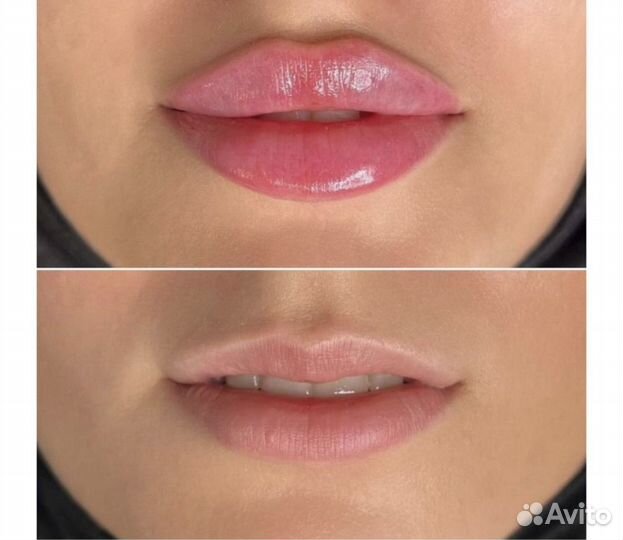 Увеличение губ без боли
