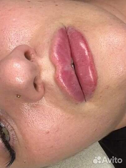 Увеличение губ