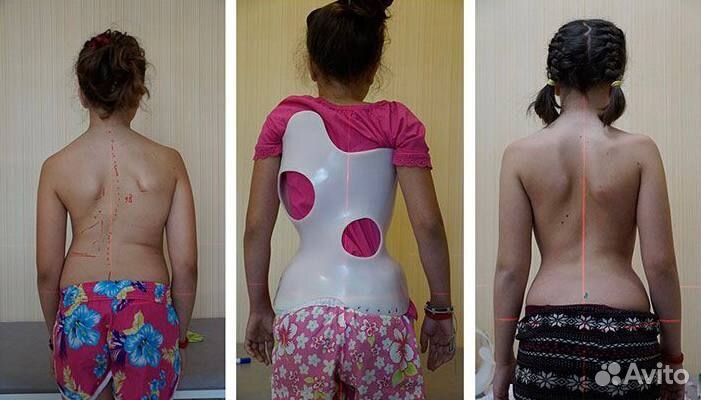 Лечение сколиоза корсетом Шено