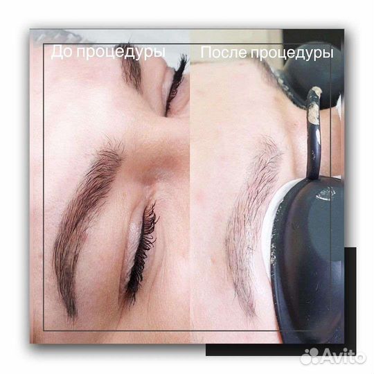 Лазерное удаление тату и татуажа