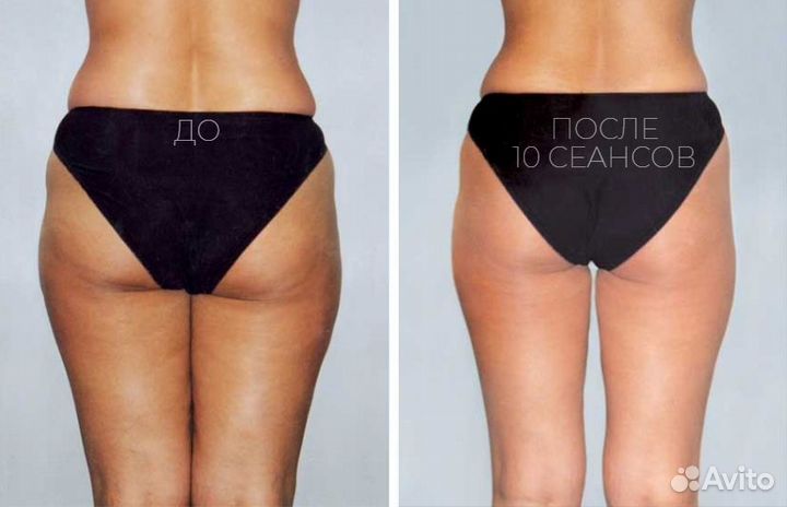 Мадеротерапия / Антицеллюлитный массаж