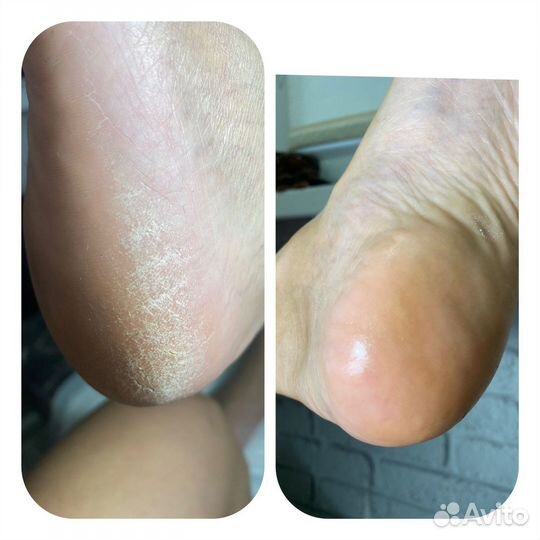 Smart педикюр медицинский педикюр