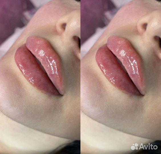 Увеличение губ модель