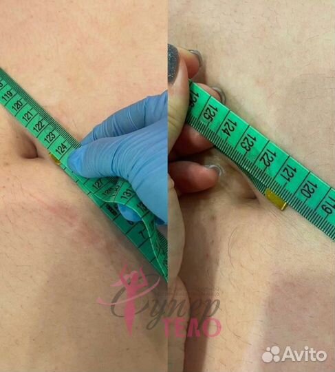 Кавитация/Вакуумный массаж/Коррекция фигуры