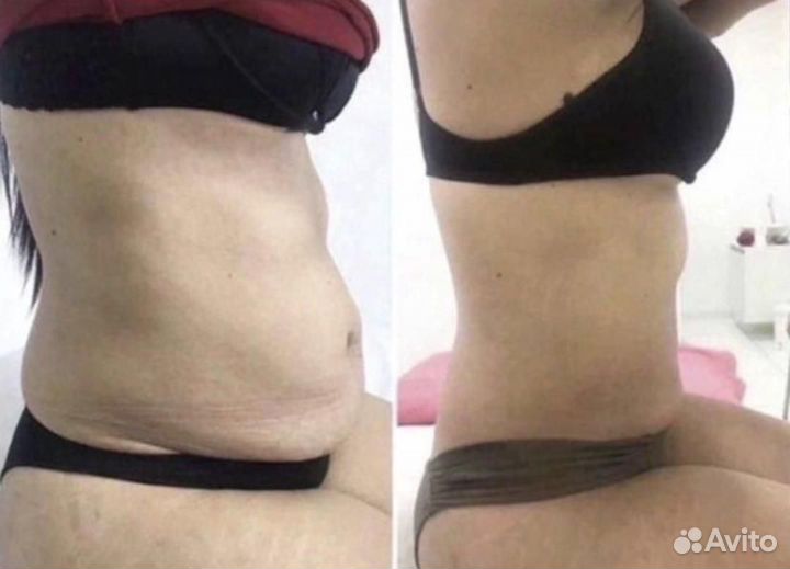 Глубокий антицеллюлитный Субдермальный массаж