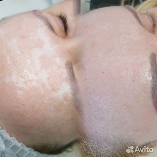 Дермопигментация, камуфляж шрамов