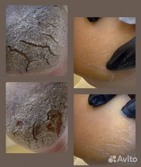 Подолог с выездом на дом