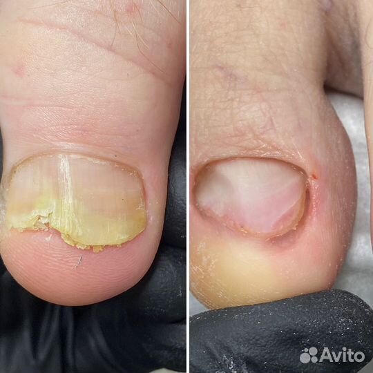 Подолог. Лечебный педикюр. Без боли