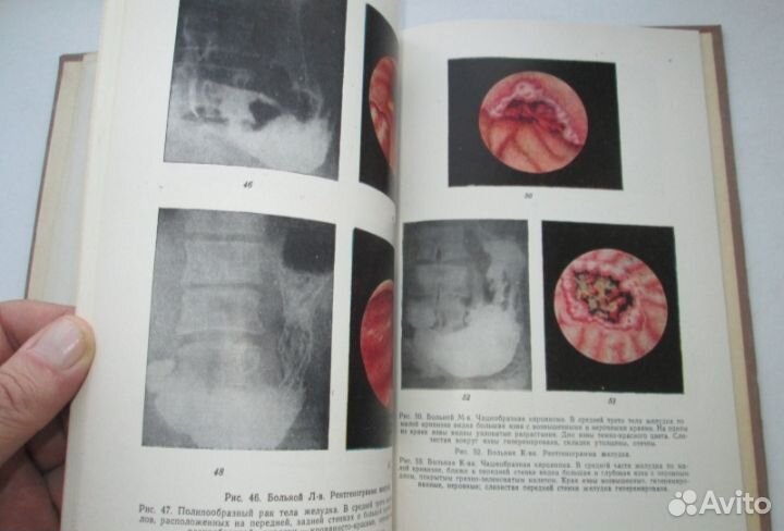 Гастроскопия в диагностике рака желудка