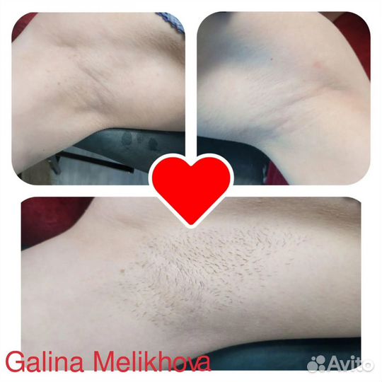 Шугаринг депиляция