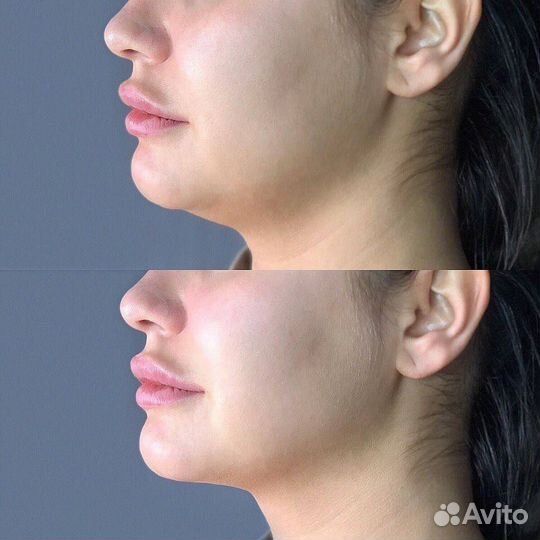 Быстрое похудение лица и тела. Липолитики