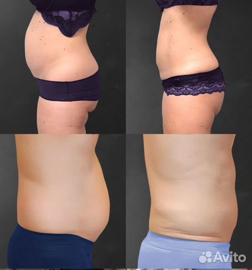 Криолиполиз / Липосакция без операций