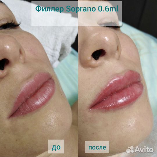 Красивые губы, увлажнение губ, Биоревитализация