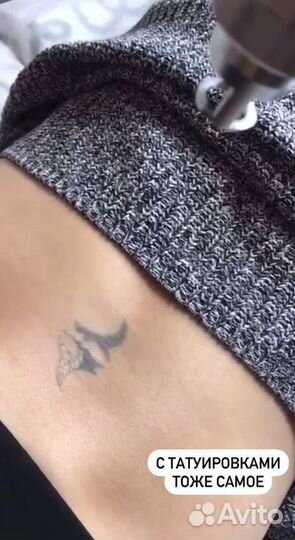 Лазерное удаление тату