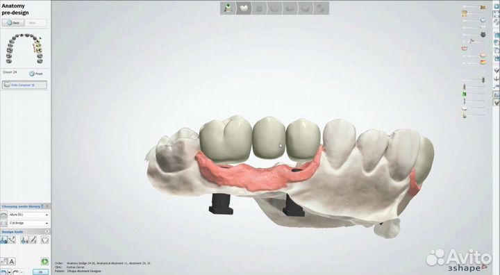 Hyperdent/3shape/ExoCad/3Diagnosys PlastyCad