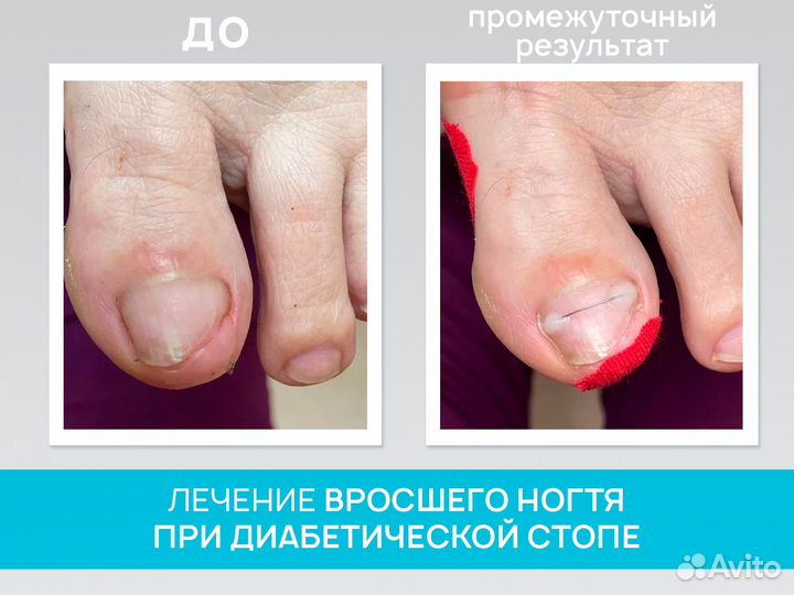 Подолог, медицинский педикюр при сдс, обработка